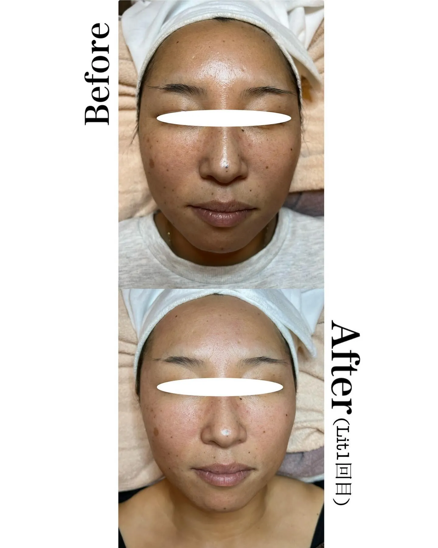 フェイスワックス+Litトリートメント✨️