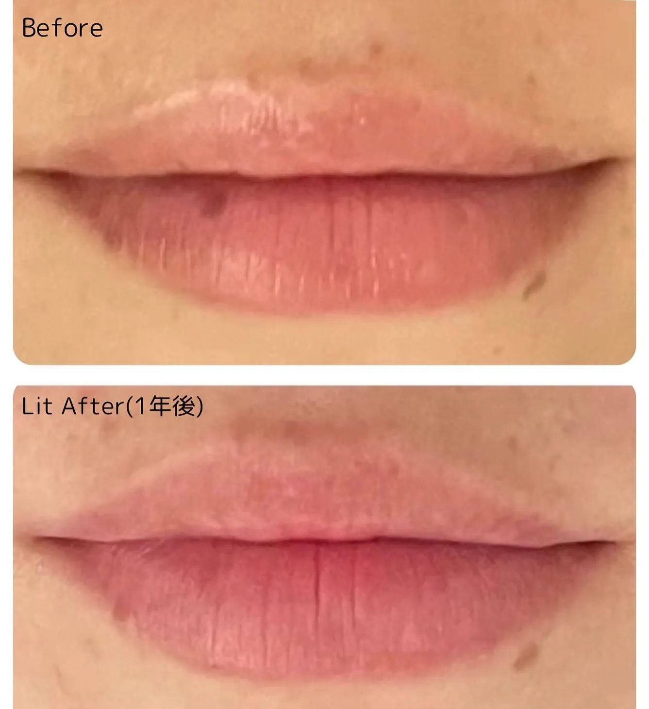 唇💋のシミが・・・!!!